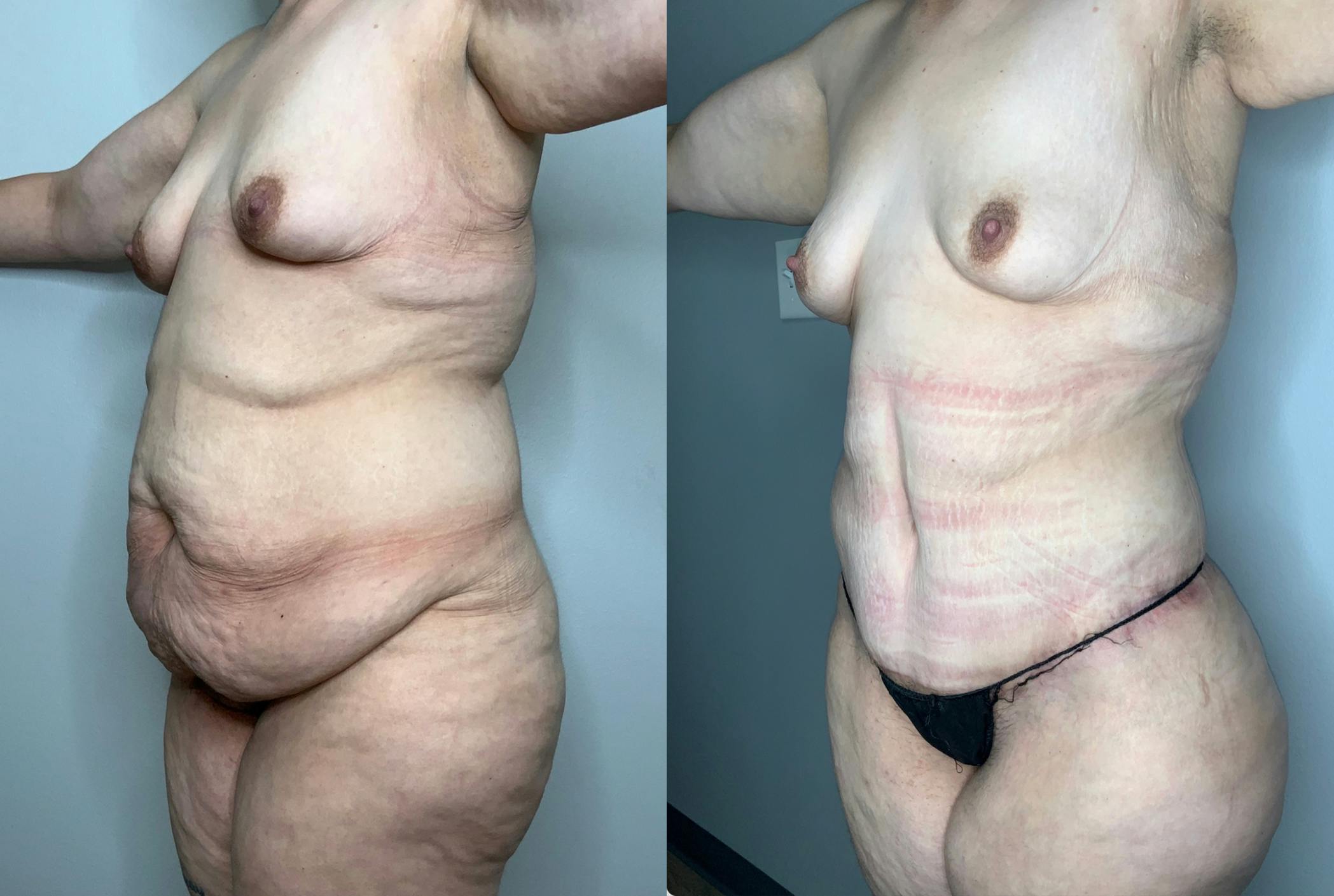 Liposuction Before & After Gallery - Patient 59474627 - Image 3