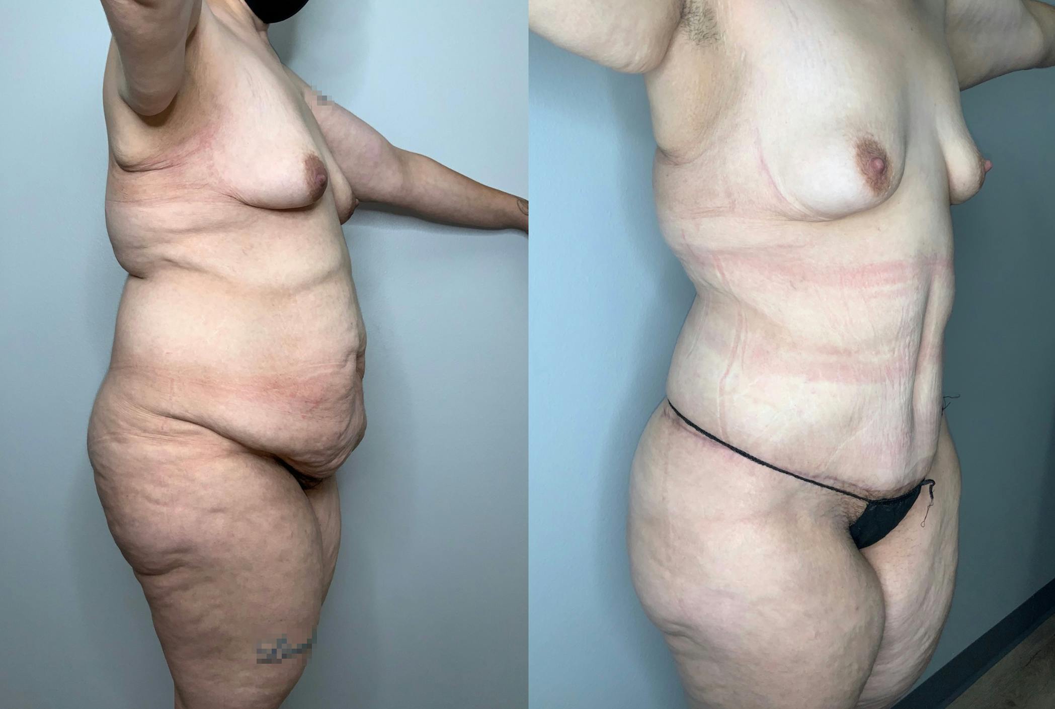Tummy Tuck Gallery - Patient 59474626 - Image 3