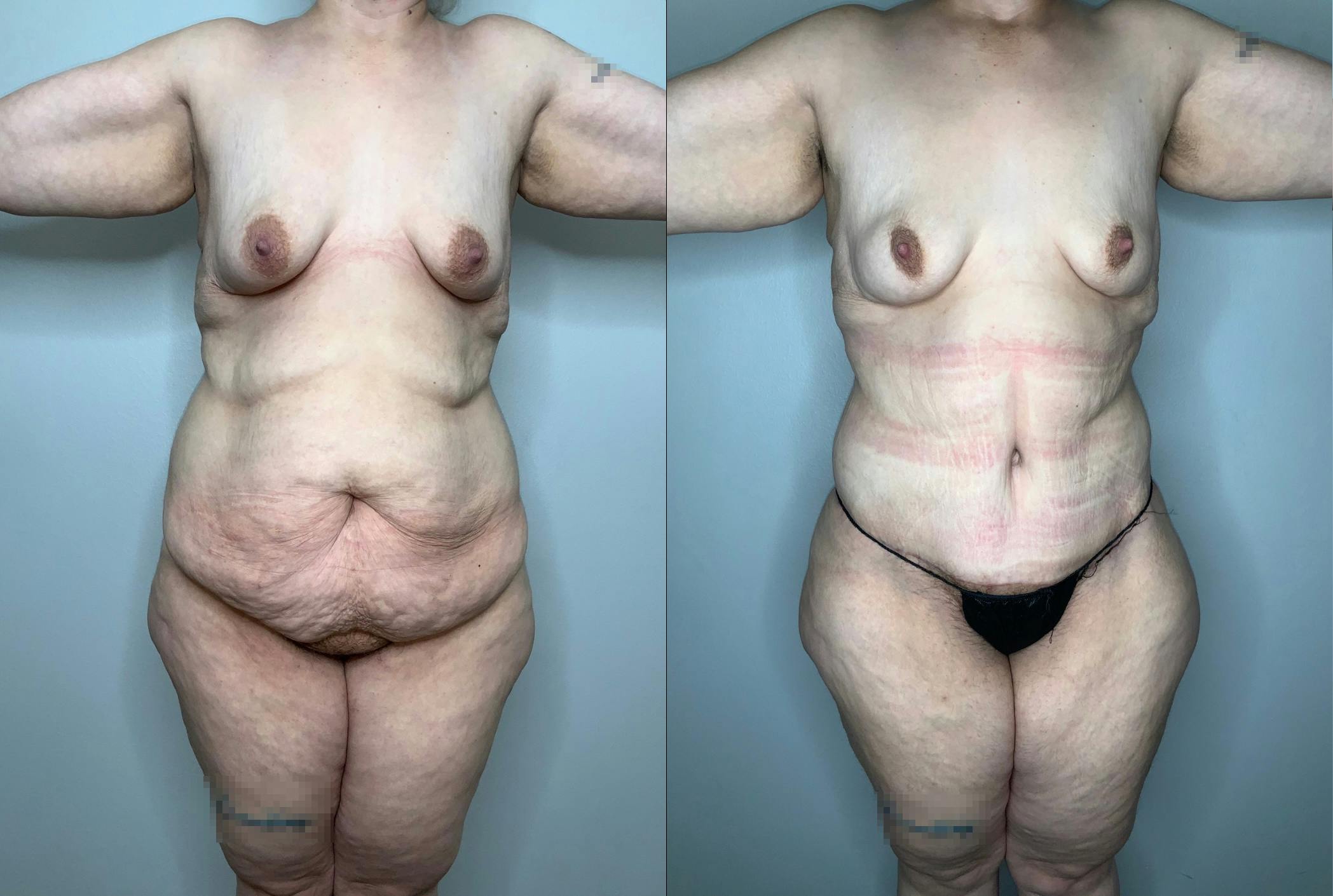 Liposuction Before & After Gallery - Patient 59474627 - Image 1