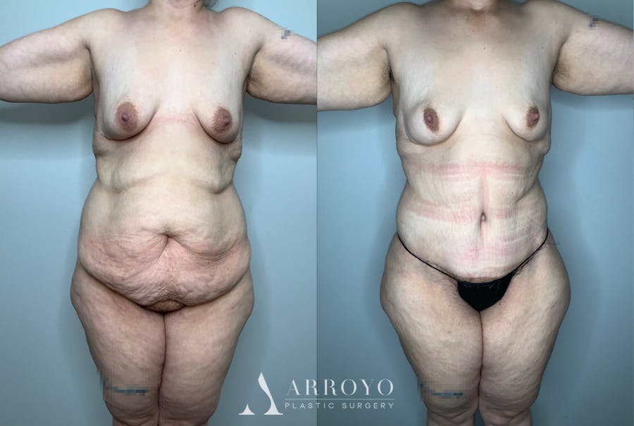 Brazilian Butt Lift Before & After Gallery - Patient 59474630 - Image 4