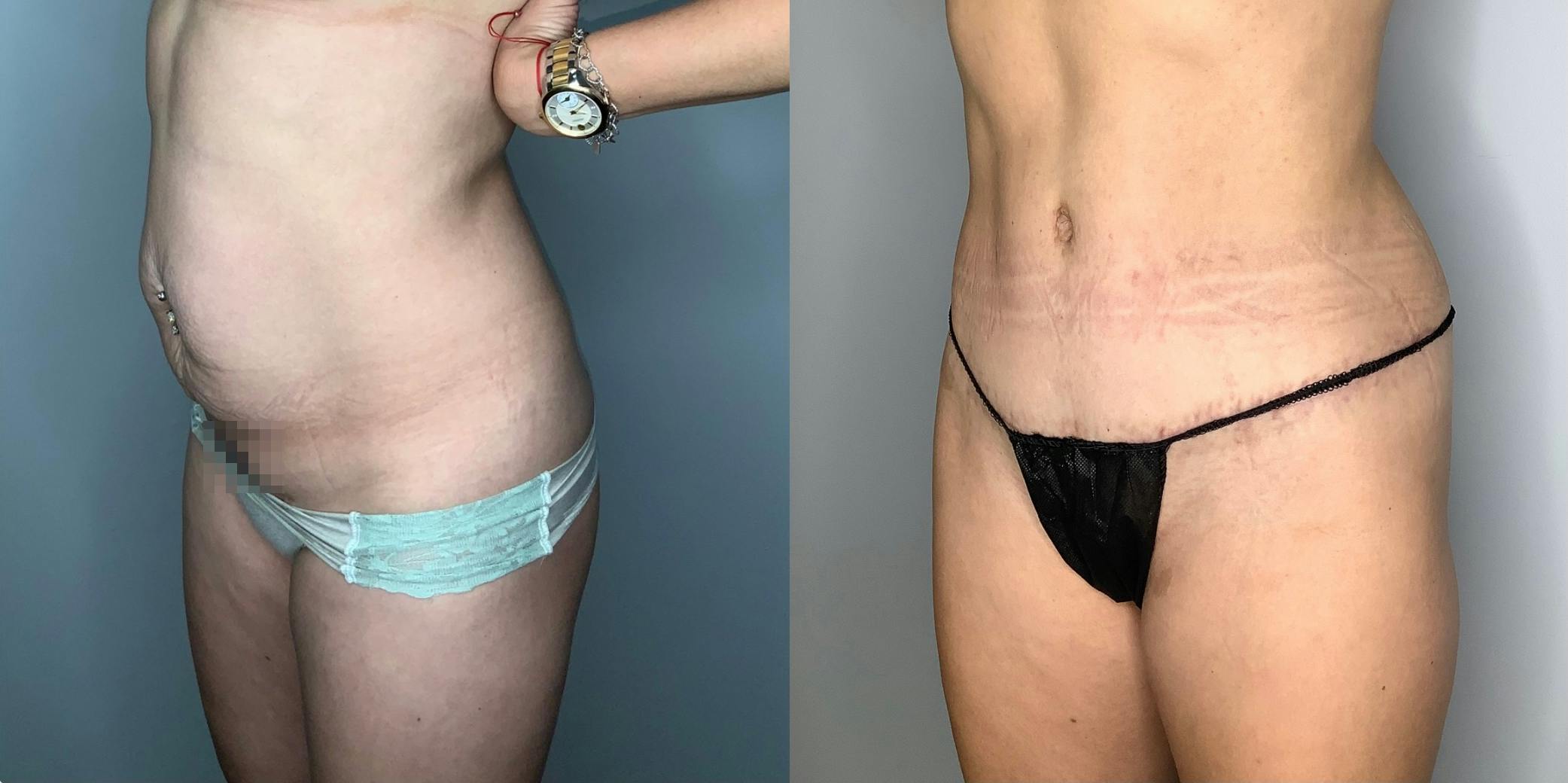 Liposuction Before & After Gallery - Patient 59474651 - Image 6