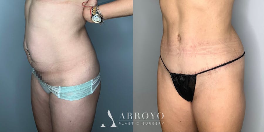 Tummy Tuck Before & After Gallery - Patient 59474647 - Image 2