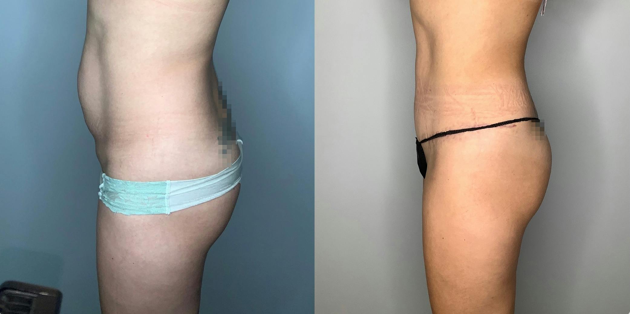 before and after of a Houston tummy tuck patient