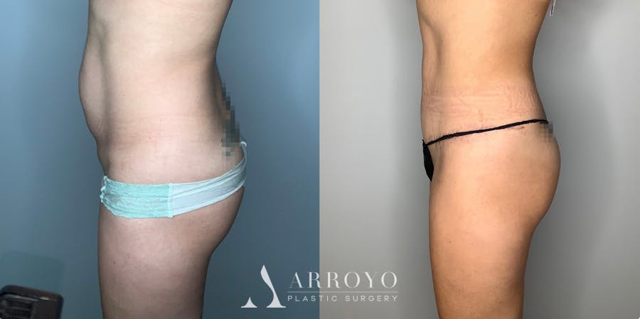 Tummy Tuck Before & After Gallery - Patient 59474647 - Image 3