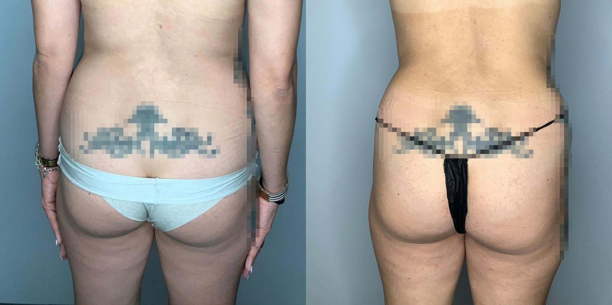 Tummy Tuck Gallery - Patient 59474647 - Image 4