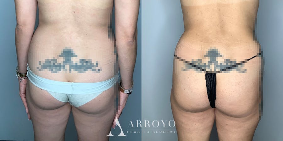 Tummy Tuck Before & After Gallery - Patient 59474647 - Image 4