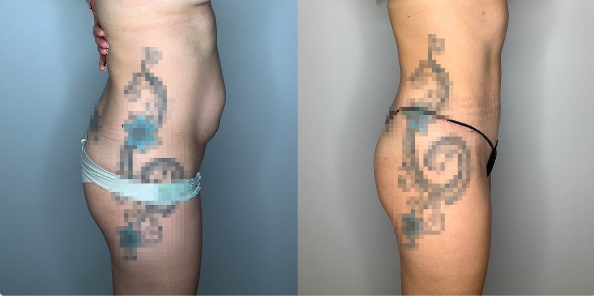 Liposuction Before & After Gallery - Patient 59474651 - Image 3