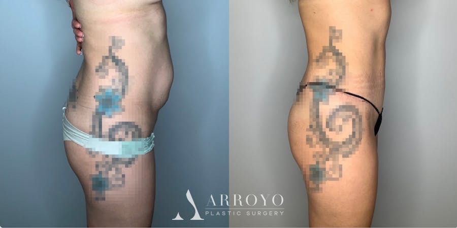 Tummy Tuck Before & After Gallery - Patient 59474647 - Image 5