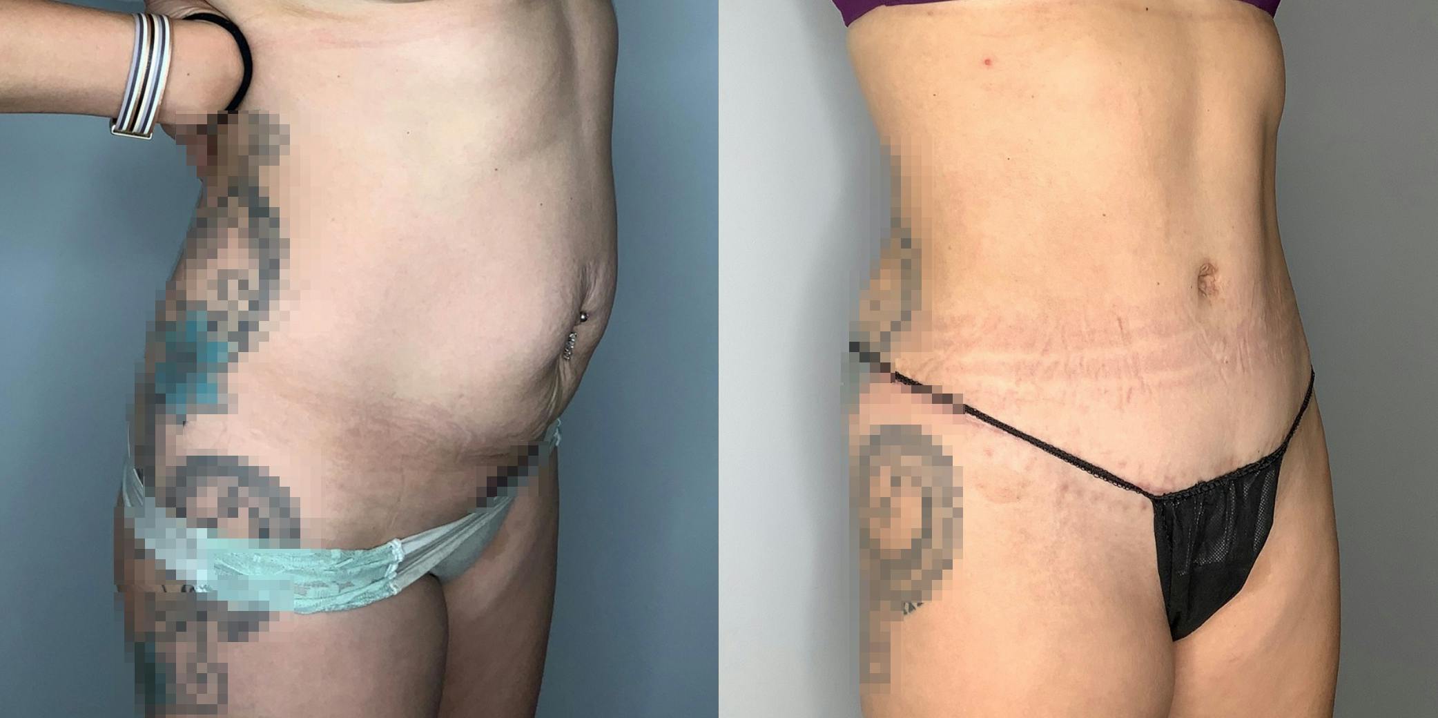 Tummy Tuck Before & After Gallery - Patient 59474647 - Image 6