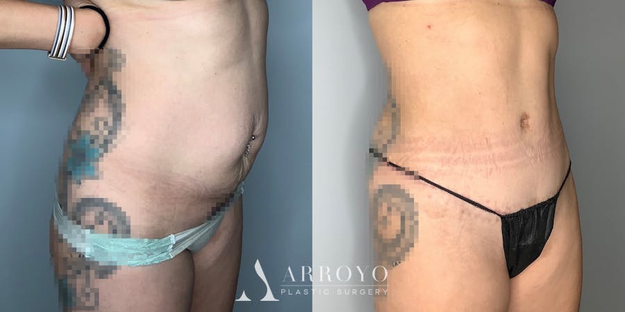 Tummy Tuck Before & After Gallery - Patient 59474647 - Image 6