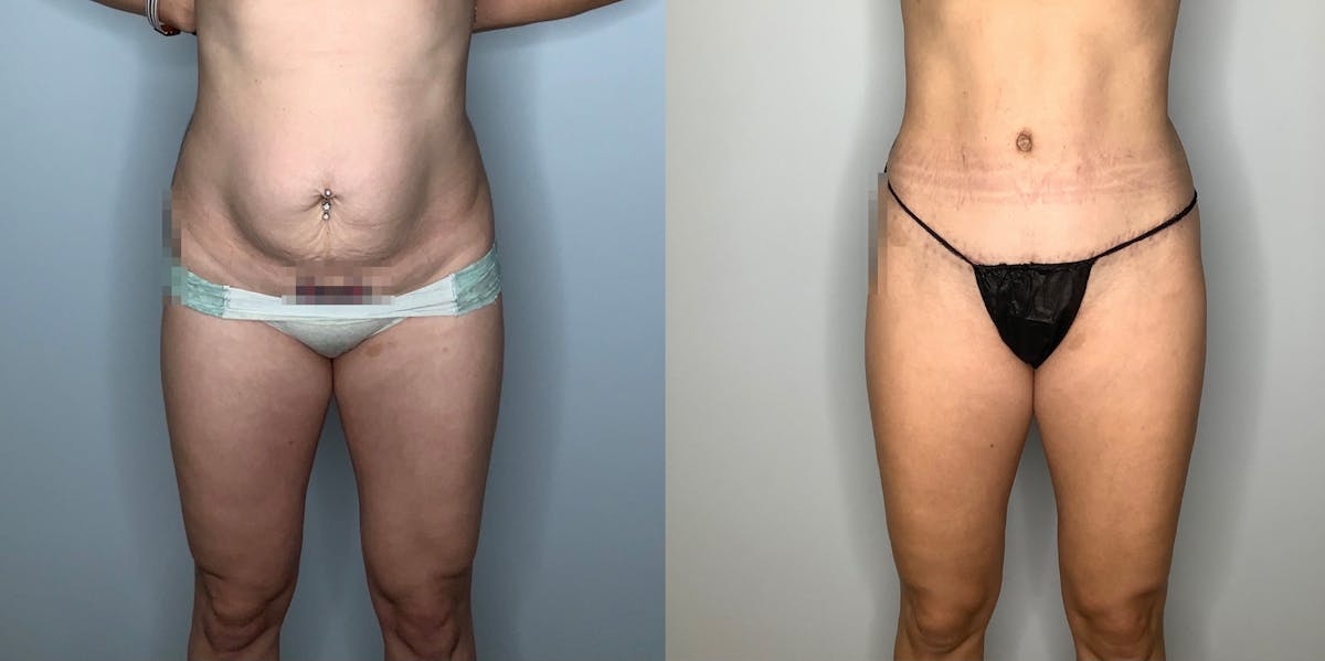 Liposuction Before & After Gallery - Patient 59474651 - Image 1