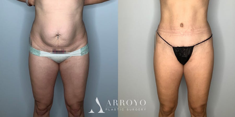 Tummy Tuck Before & After Gallery - Patient 59474647 - Image 1