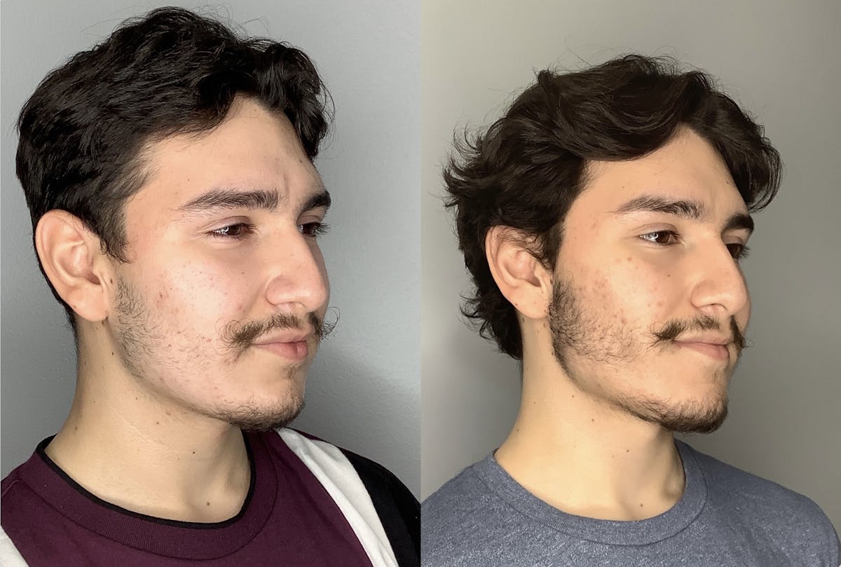 Buccal Fat Removal Before & After Gallery - Patient 59474666 - Image 2