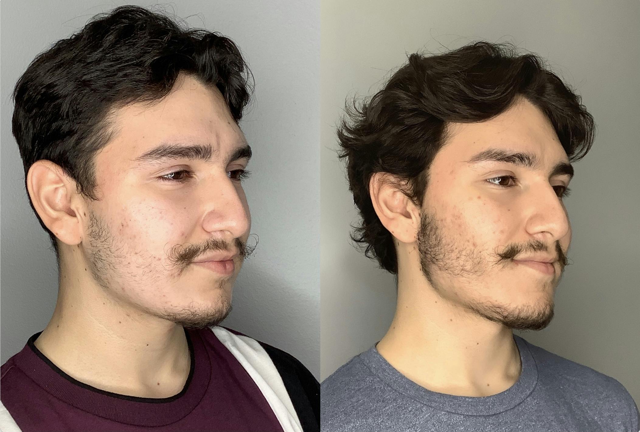 Buccal Fat Removal Before & After Gallery - Patient 59474666 - Image 2
