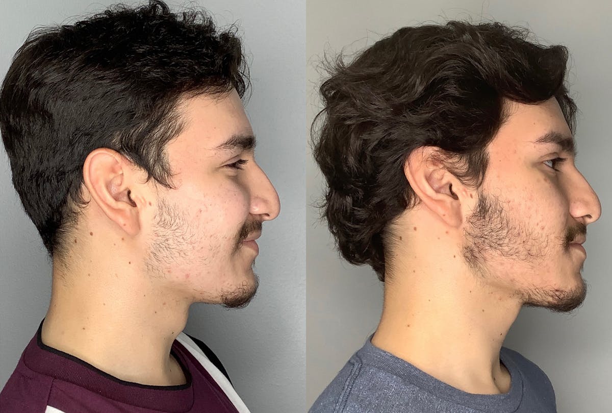 Buccal Fat Removal Before & After Gallery - Patient 59474666 - Image 3