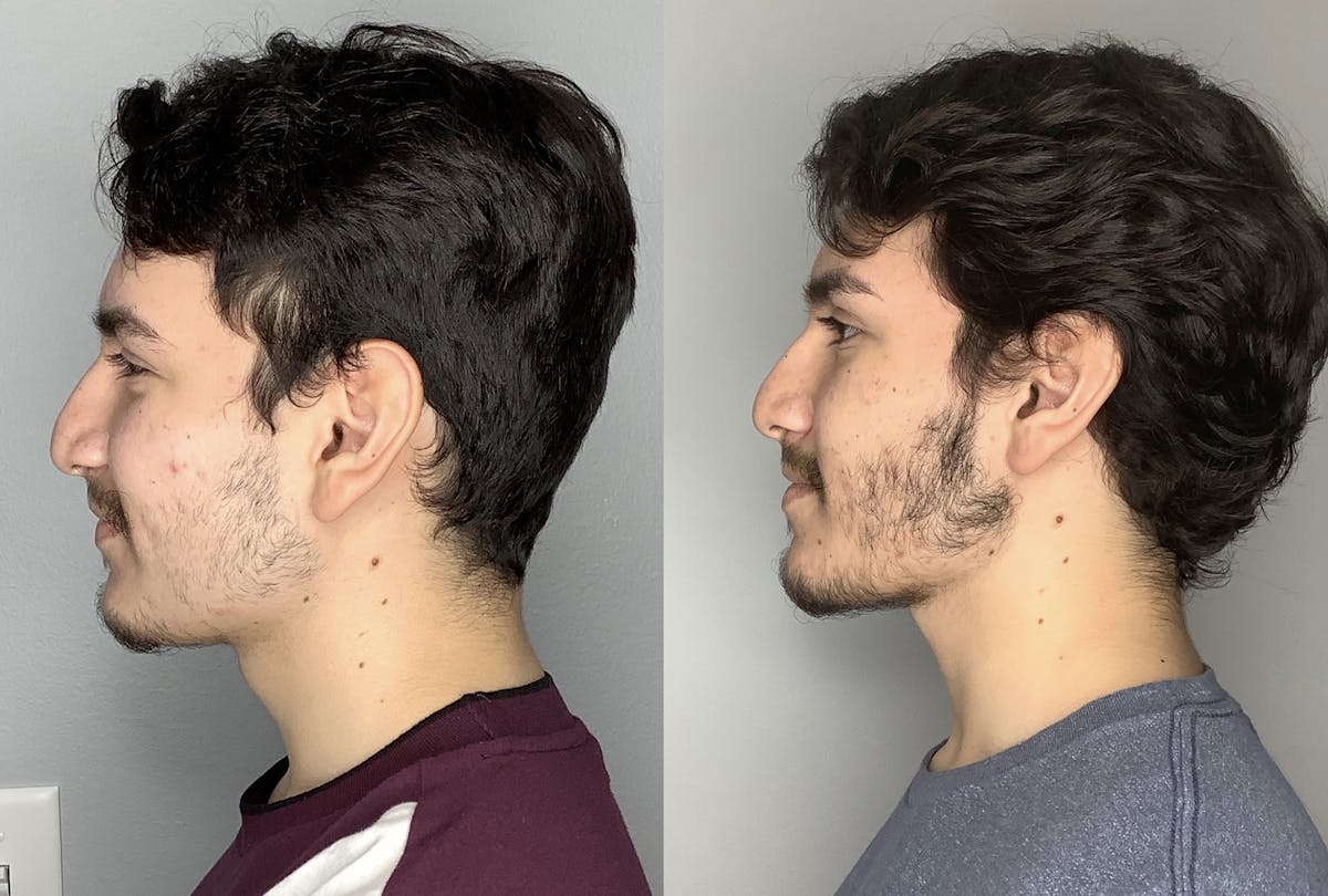 Buccal Fat Removal Before & After Gallery - Patient 59474666 - Image 4