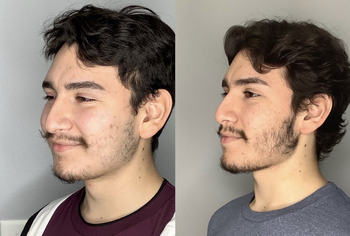 Buccal Fat Removal Before & After Gallery - Patient 59474666 - Image 5
