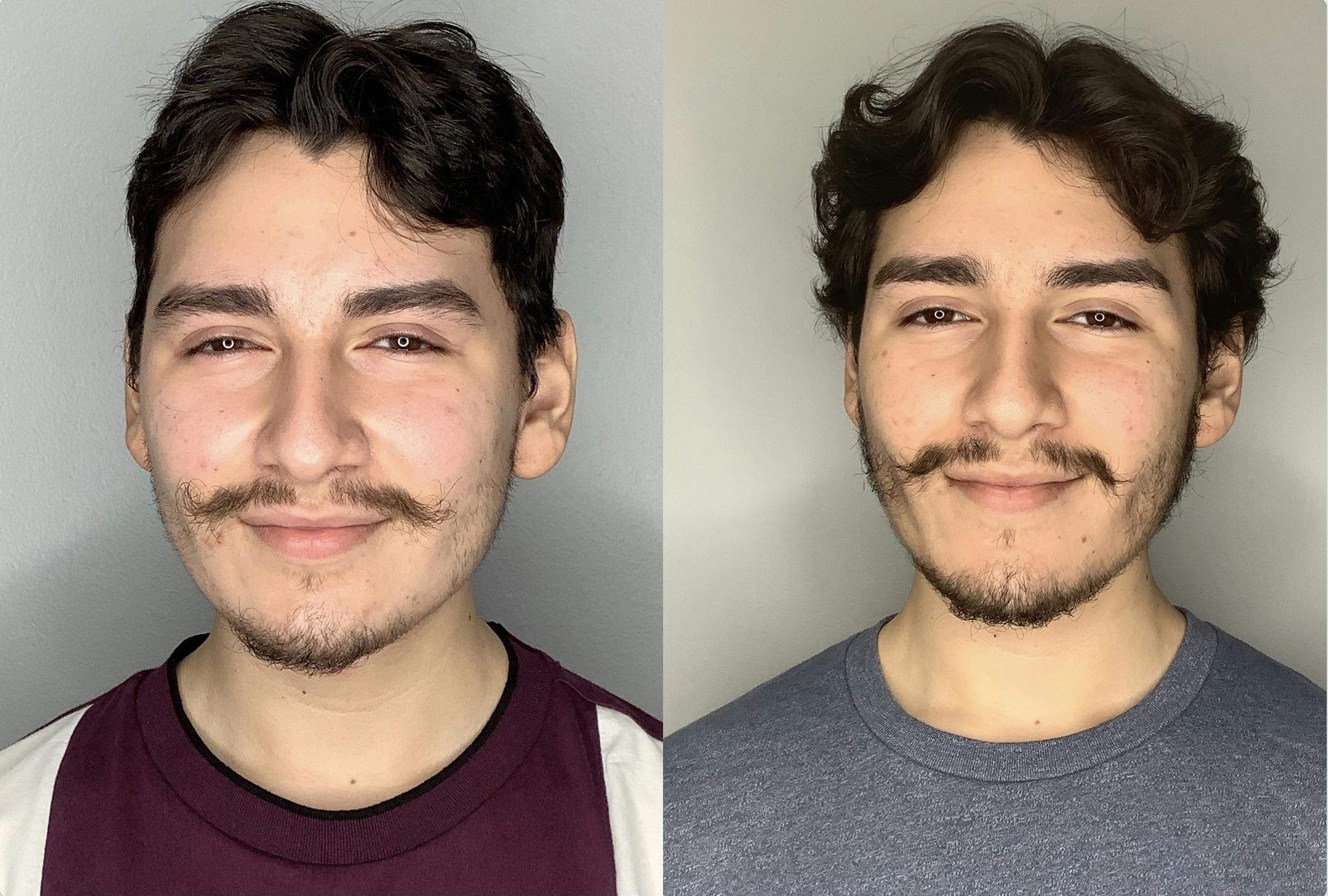 Before and After Buccal Fat Removal in Houston