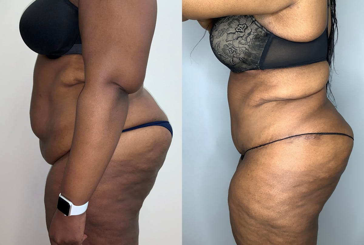 Tummy Tuck Before & After Gallery - Patient 59474677 - Image 2