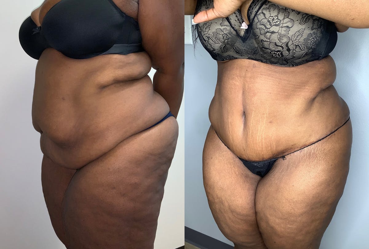 Tummy Tuck Before & After Gallery - Patient 59474677 - Image 3