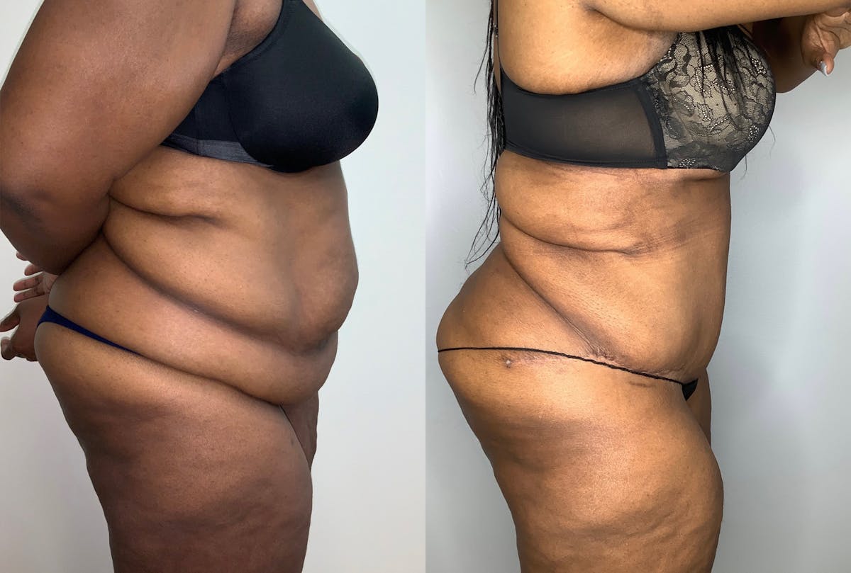 Tummy Tuck Before & After Gallery - Patient 59474677 - Image 5