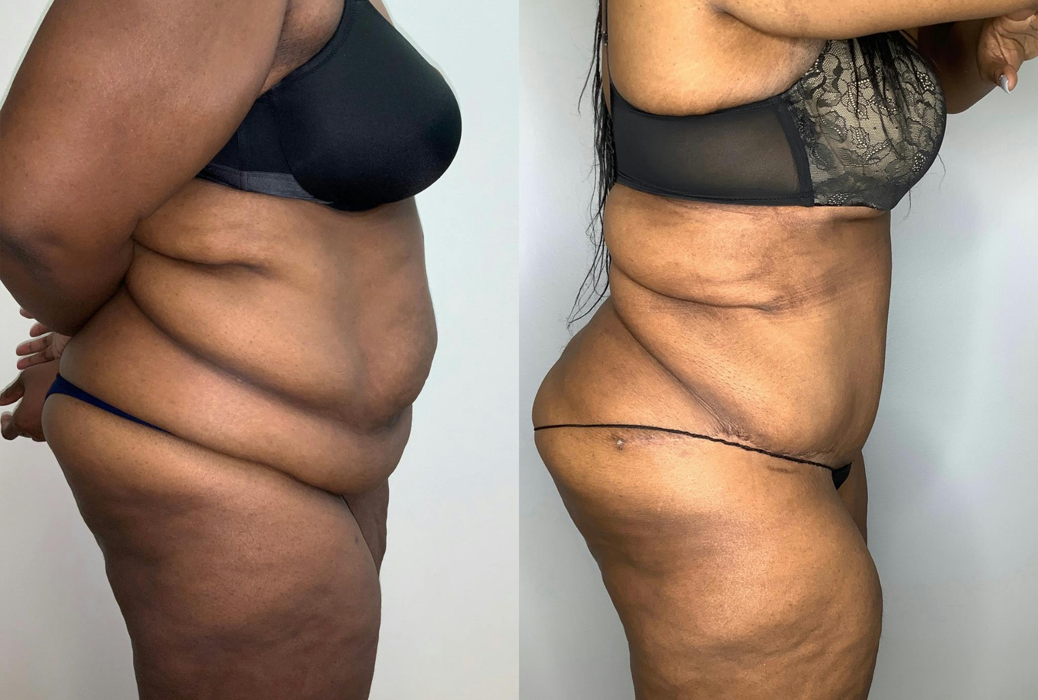 Tummy Tuck Before & After Gallery - Patient 59474677 - Image 5