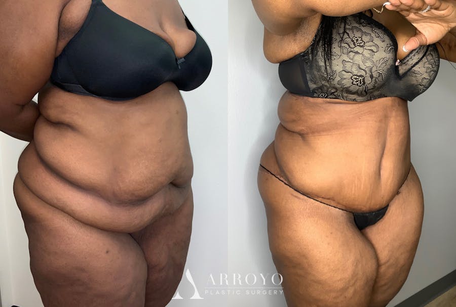 Tummy Tuck Before & After Gallery - Patient 59474677 - Image 4