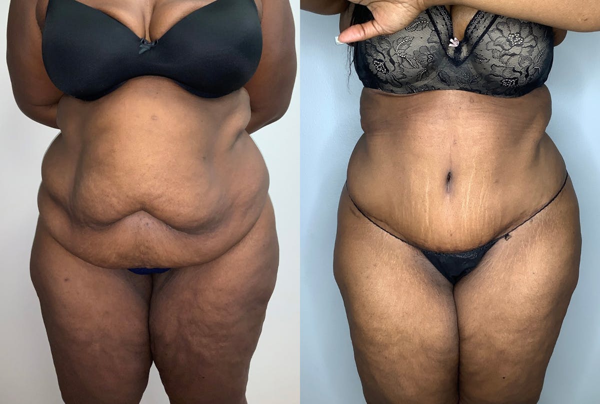 Tummy Tuck Before & After Gallery - Patient 59474677 - Image 1