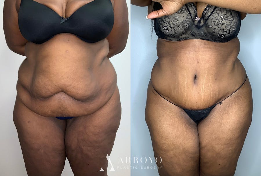 Tummy Tuck Before & After Gallery - Patient 59474677 - Image 1