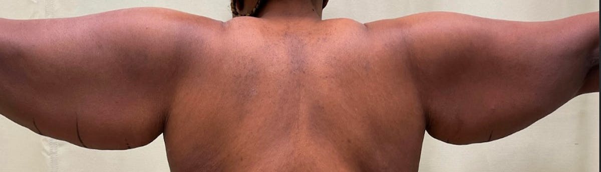 Brachioplasty (Arm Lift)  Before & After Gallery - Patient 59474681 - Image 1