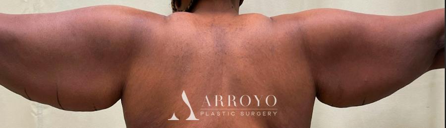 Brachioplasty (Arm Lift) Before & After Gallery - Patient 59474681 - Image 1