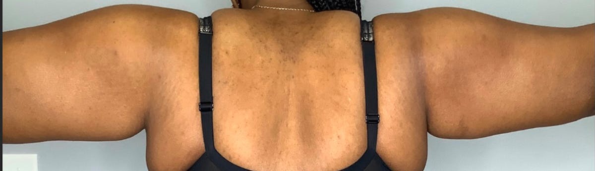 Brachioplasty (Arm Lift)  Before & After Gallery - Patient 59474681 - Image 2