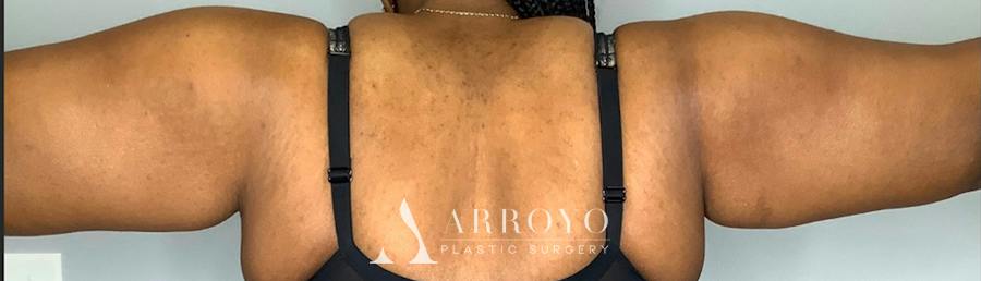 Brachioplasty (Arm Lift) Before & After Gallery - Patient 59474681 - Image 2