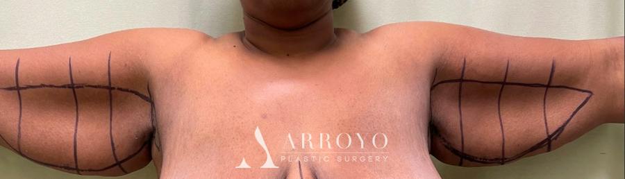 Brachioplasty (Arm Lift) Before & After Gallery - Patient 59474681 - Image 3