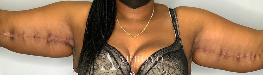 Brachioplasty (Arm Lift) Before & After Gallery - Patient 59474681 - Image 4