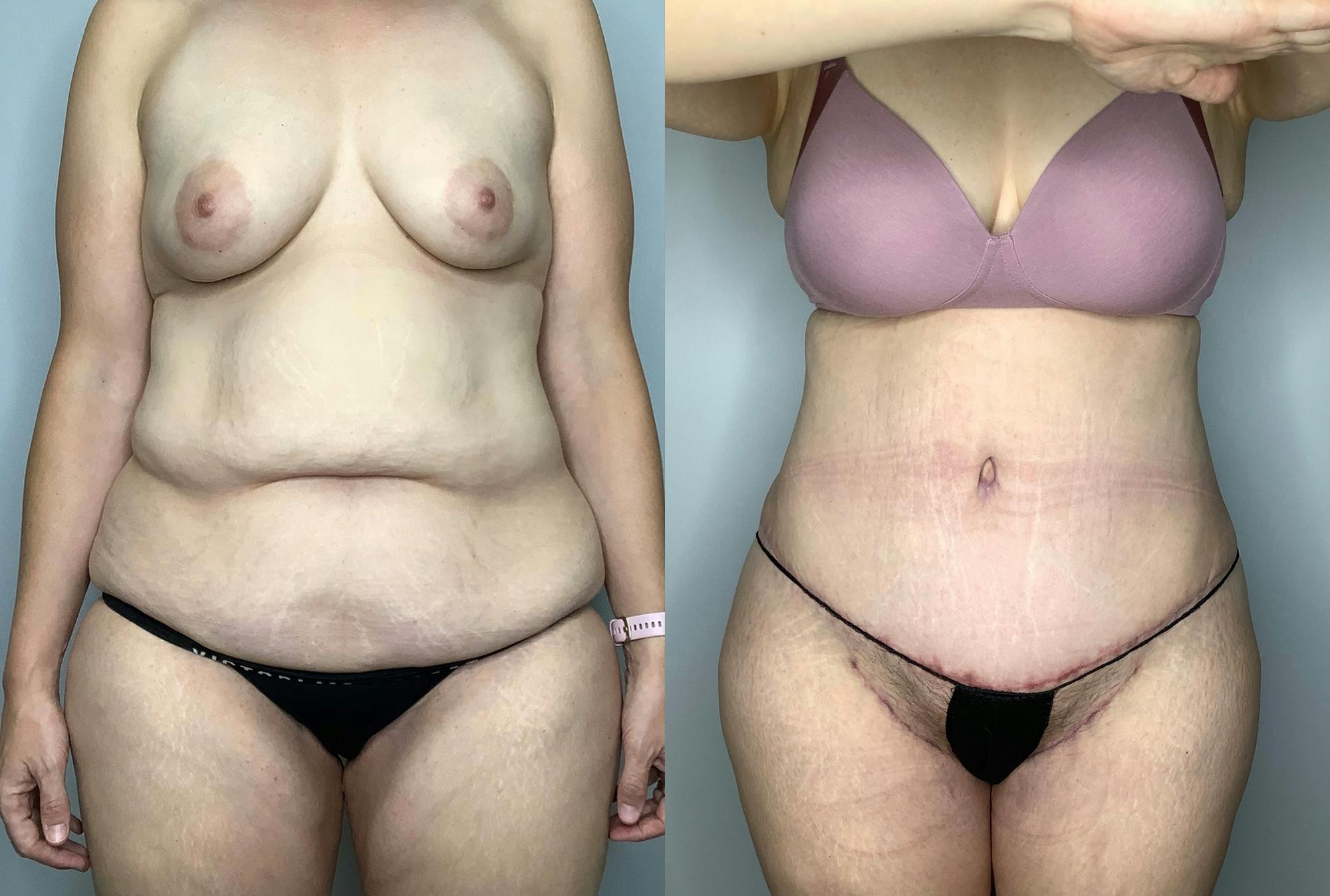 Thigh Lift Before & After Gallery - Patient 64670006 - Image 1