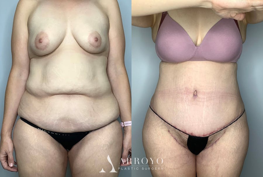 Tummy Tuck Before & After Gallery - Patient 64670005 - Image 1