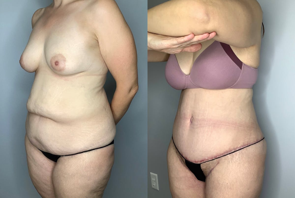 Tummy Tuck Before & After Gallery - Patient 64670005 - Image 2