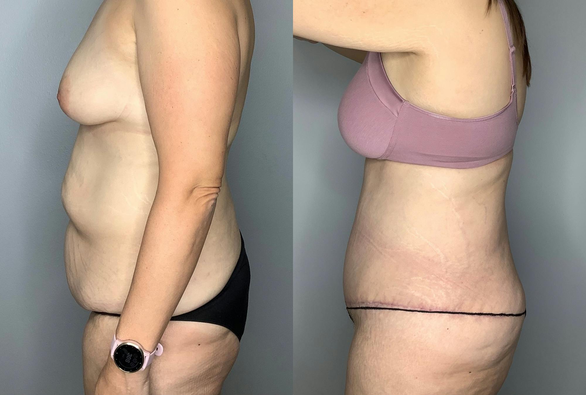 patient before and after photo of a tummy tuck in Houston - 01