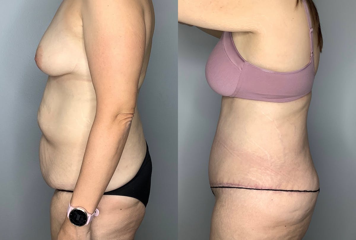 Tummy Tuck Before & After Gallery - Patient 64670005 - Image 3