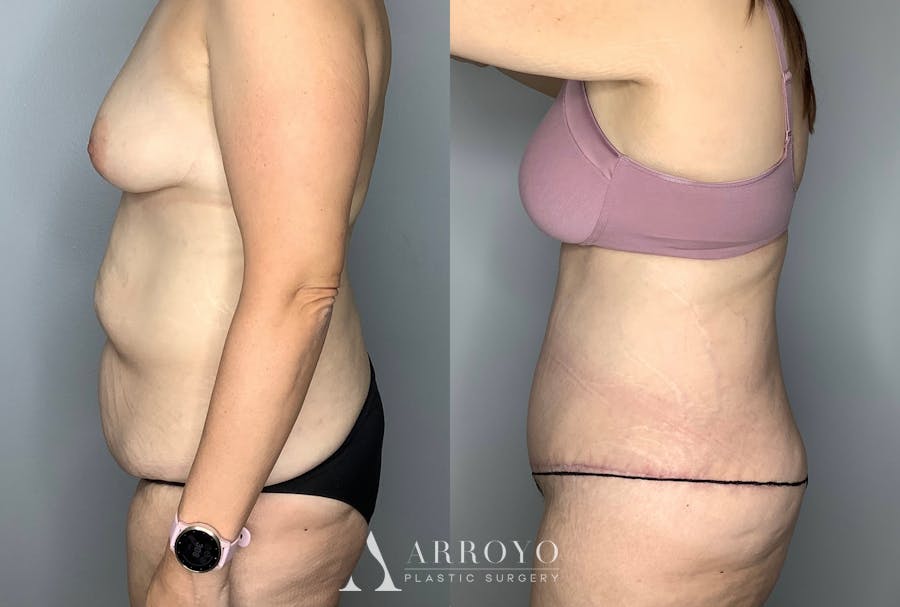 Tummy Tuck Before & After Gallery - Patient 64670005 - Image 3