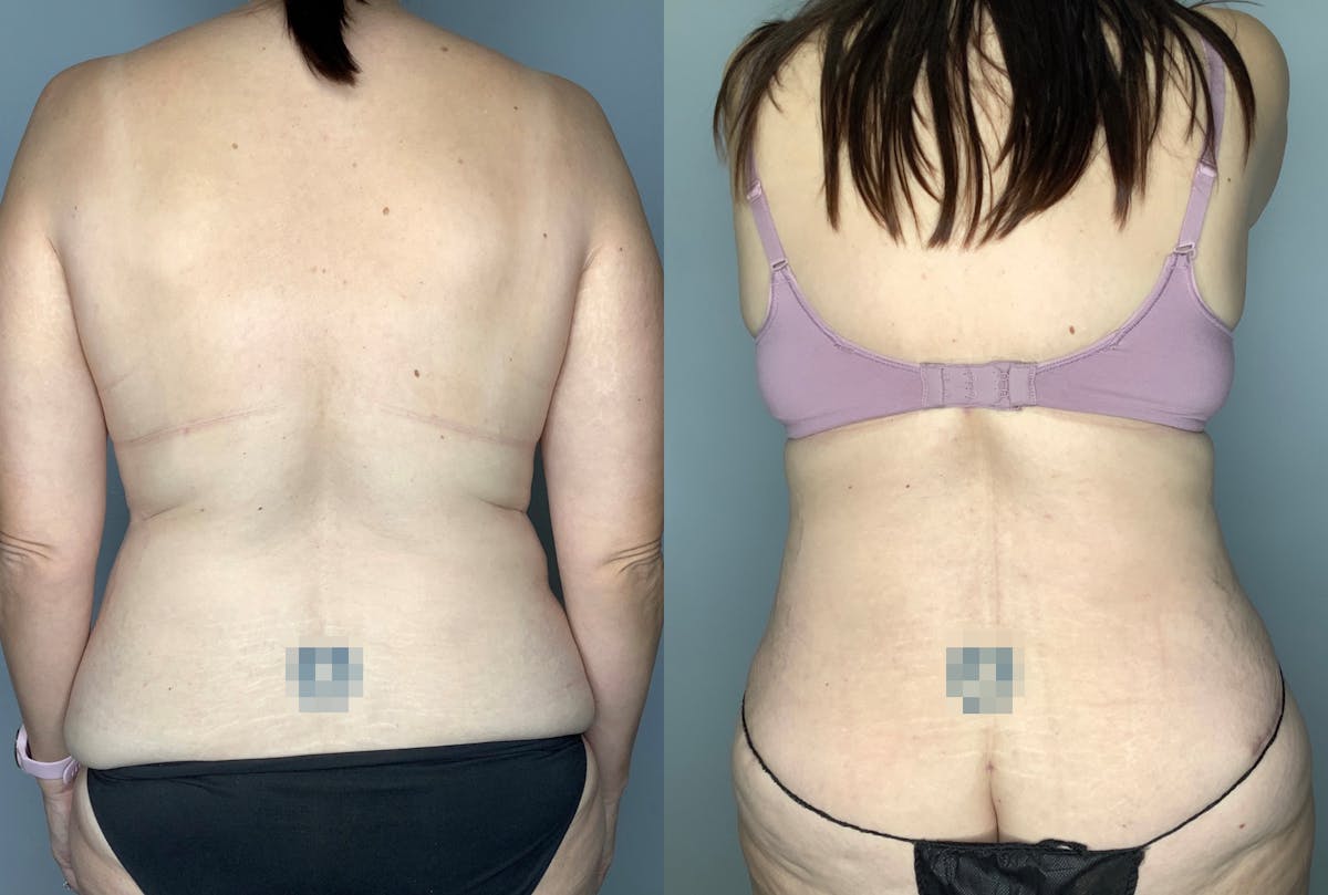 Tummy Tuck Before & After Gallery - Patient 64670005 - Image 4