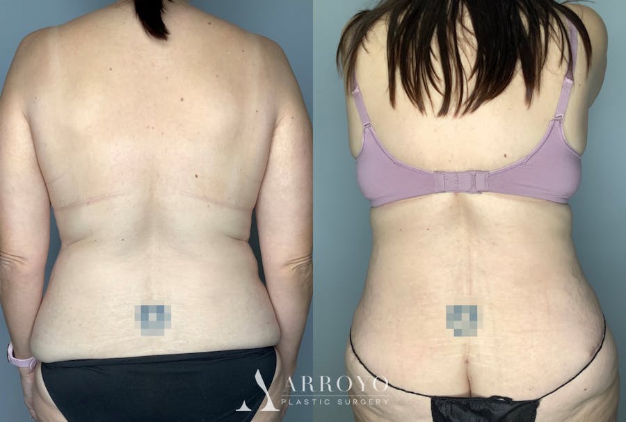 Tummy Tuck Before & After Gallery - Patient 64670005 - Image 4