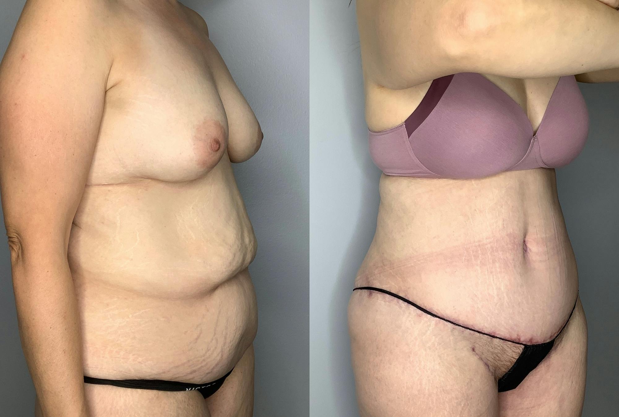 Tummy Tuck Gallery - Patient 64670005 - Image 5