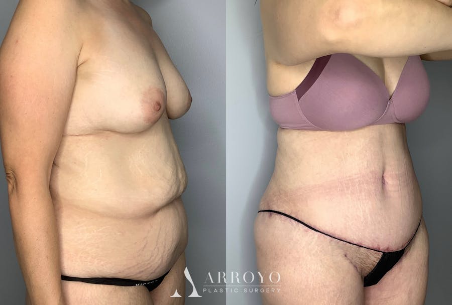 Tummy Tuck Before & After Gallery - Patient 64670005 - Image 5