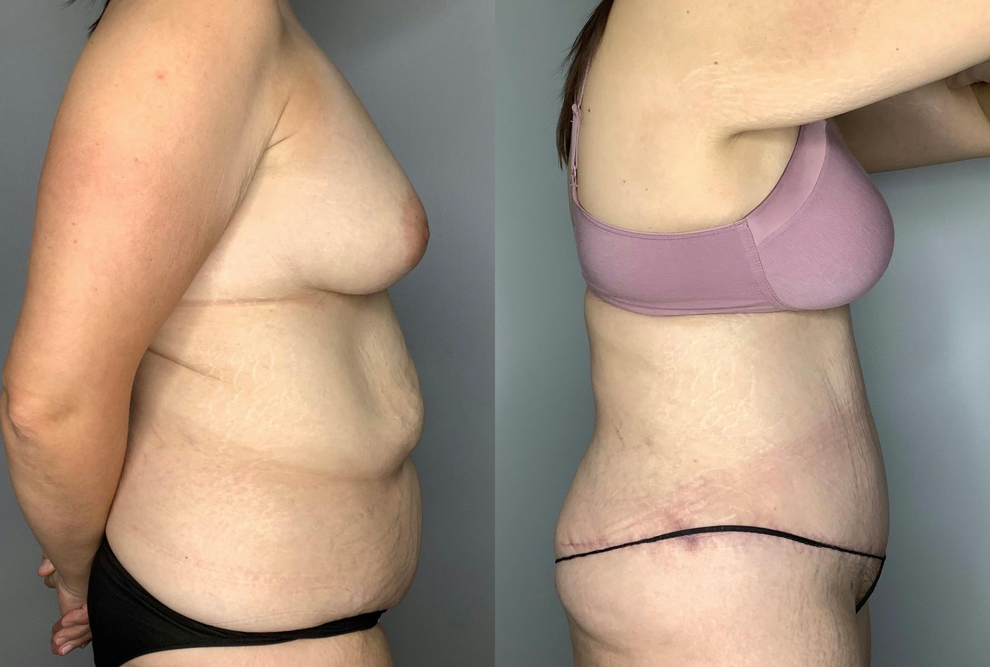 Tummy Tuck Gallery - Patient 64670005 - Image 6