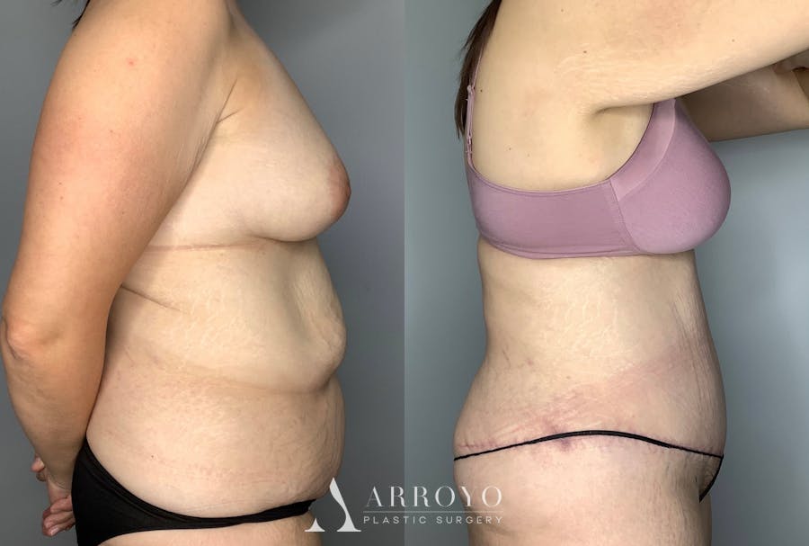 Tummy Tuck Before & After Gallery - Patient 64670005 - Image 6
