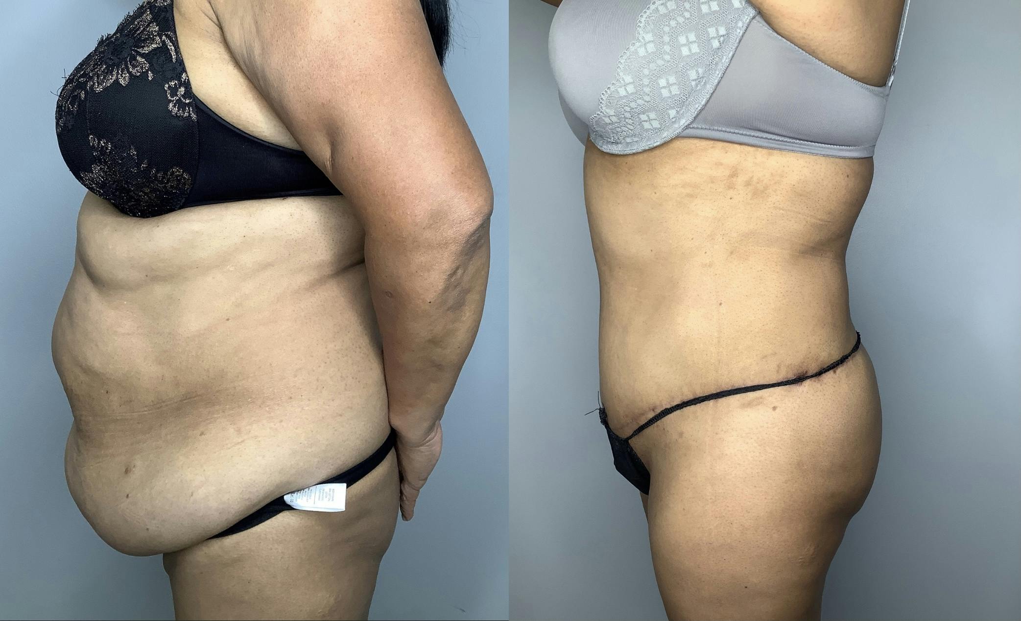 Liposuction Before & After Gallery - Patient 66768227 - Image 3