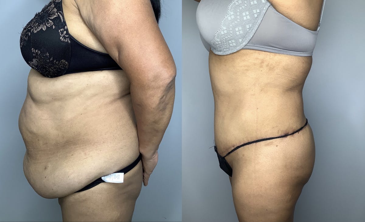 Tummy Tuck Before & After Gallery - Patient 66768190 - Image 3