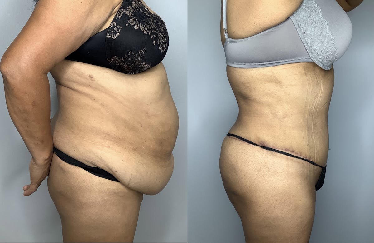Tummy Tuck Before & After Gallery - Patient 66768190 - Image 6